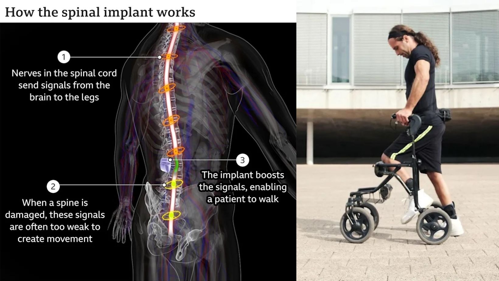 Scientific Discovery Enables Paralyzed People To Walk Again Through A