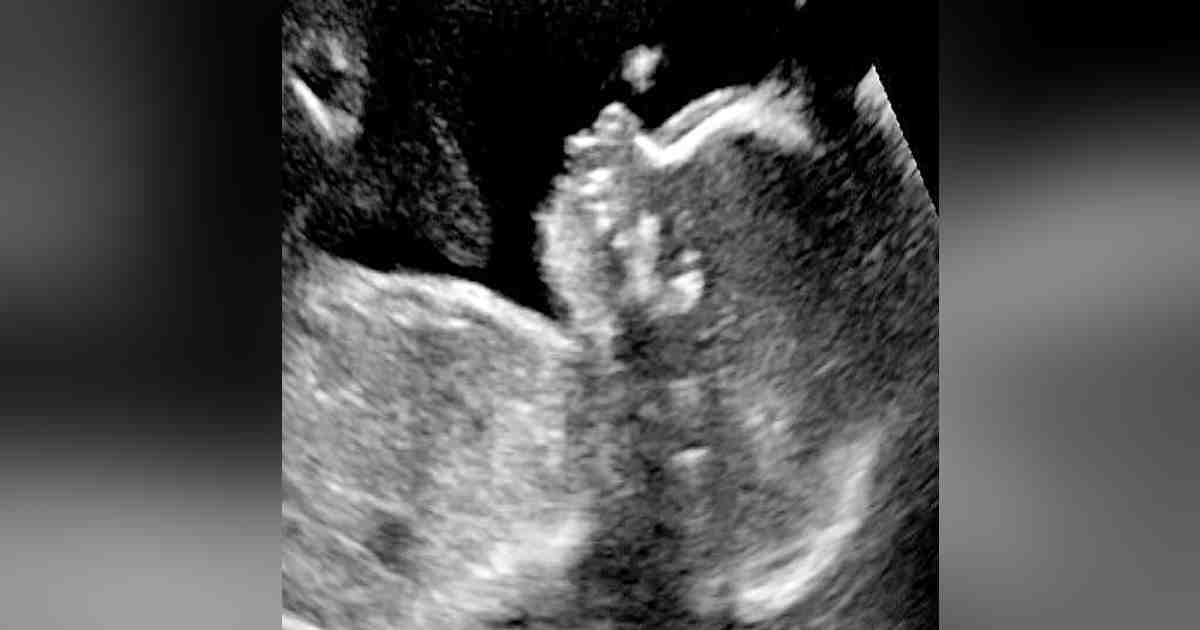 hair on ultrasound