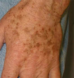 Image via Toronto Dermatology Center