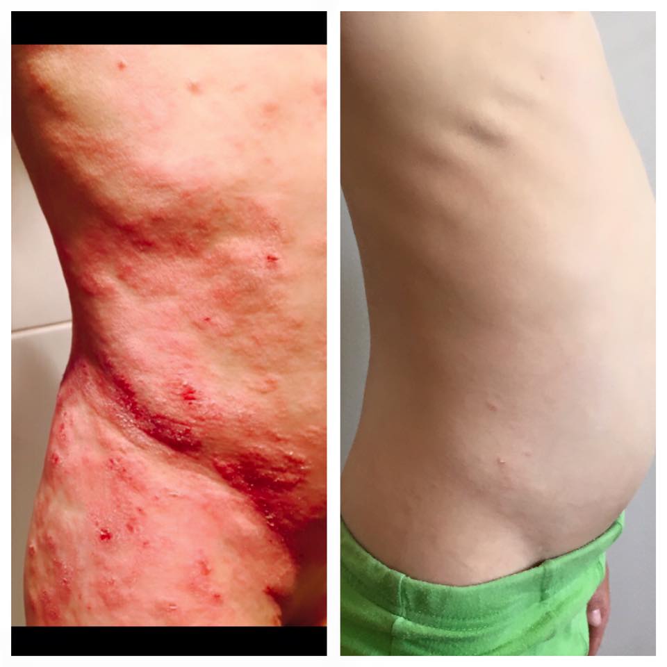 The Eczema covered Tyler's entire body. Image via Debbie Maddalena-Saunders / Facebook