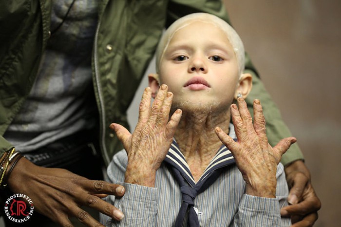 Prosthetic Renaissance