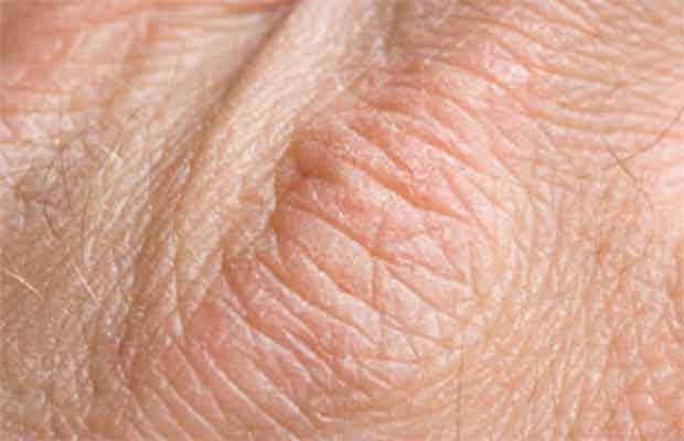dry-skin-symptoms