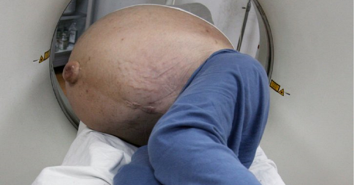 Man Who Constipated For 22 Years, Finally Removed 30 Pounds Waste