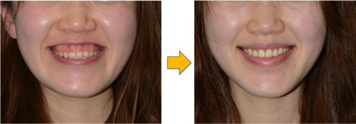 ガミースマイル 手術에 대한 이미지 검색결과