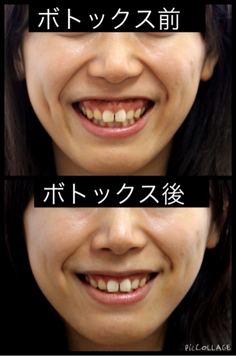 ガミースマイル ボトックス에 대한 이미지 검색결과