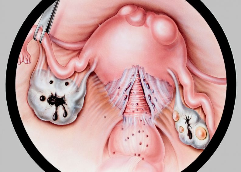 endometriose no utero 116 400x1000