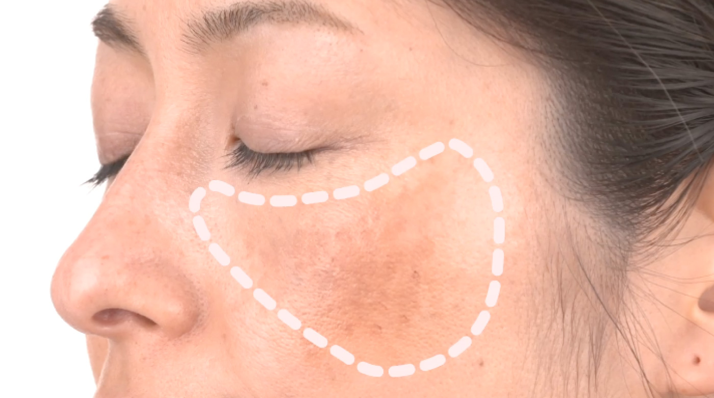 シミ에 대한 이미지 검색결과