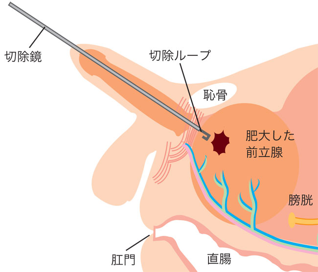 Image result for 前立腺 手術