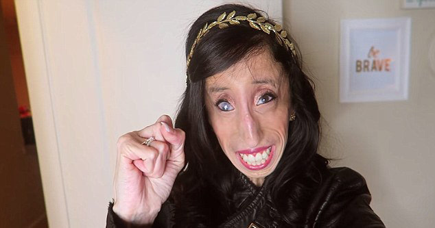lizzie-velasquez-marfan-syndrome-3