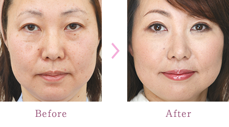 Image result for 整形 若返り