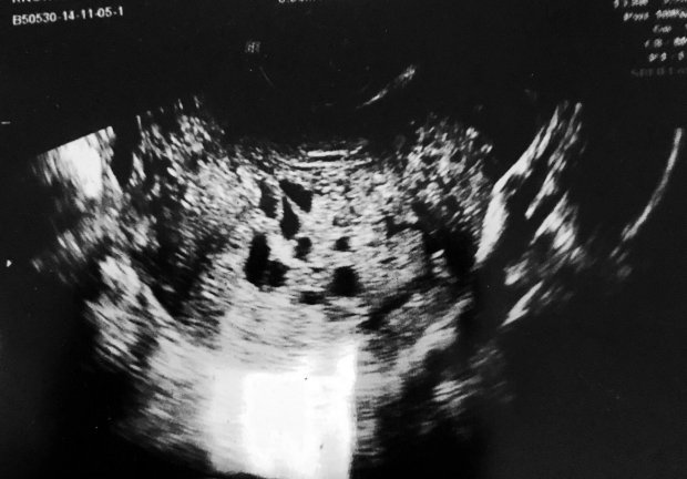 Image result for lauren pregnant cancer push