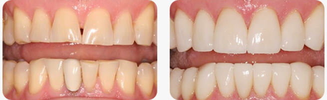 芸能人の歯 セラミック에 대한 이미지 검색결과