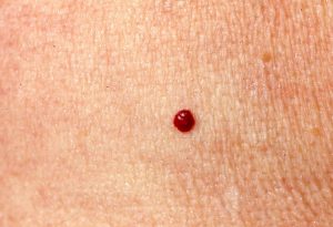 The Red Spots That May Cover Your Body Are Blood Vessels Called Cherry ...