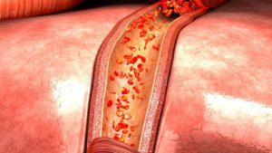 fibromyalgia-_mystery-_solved2