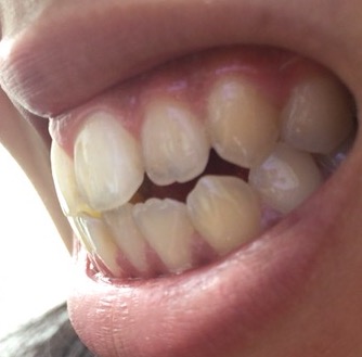 アデノイド 顔貌 歯並び에 대한 이미지 검색결과