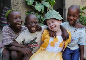 アルビノ　アフリカの子供에 대한 이미지 검색결과