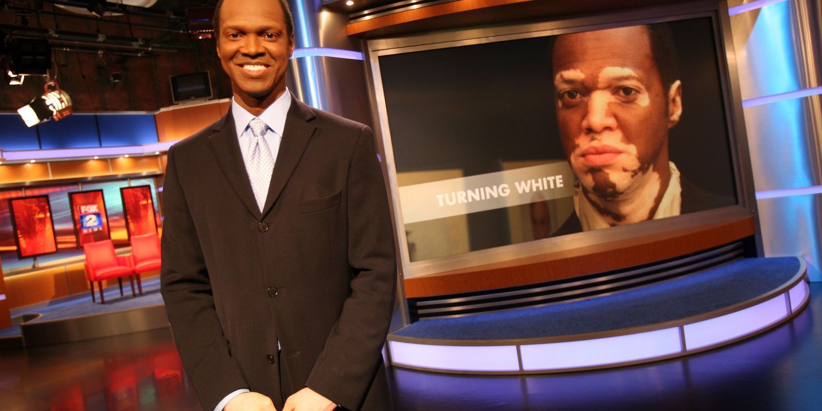 lee-thomas-vitiligo-3