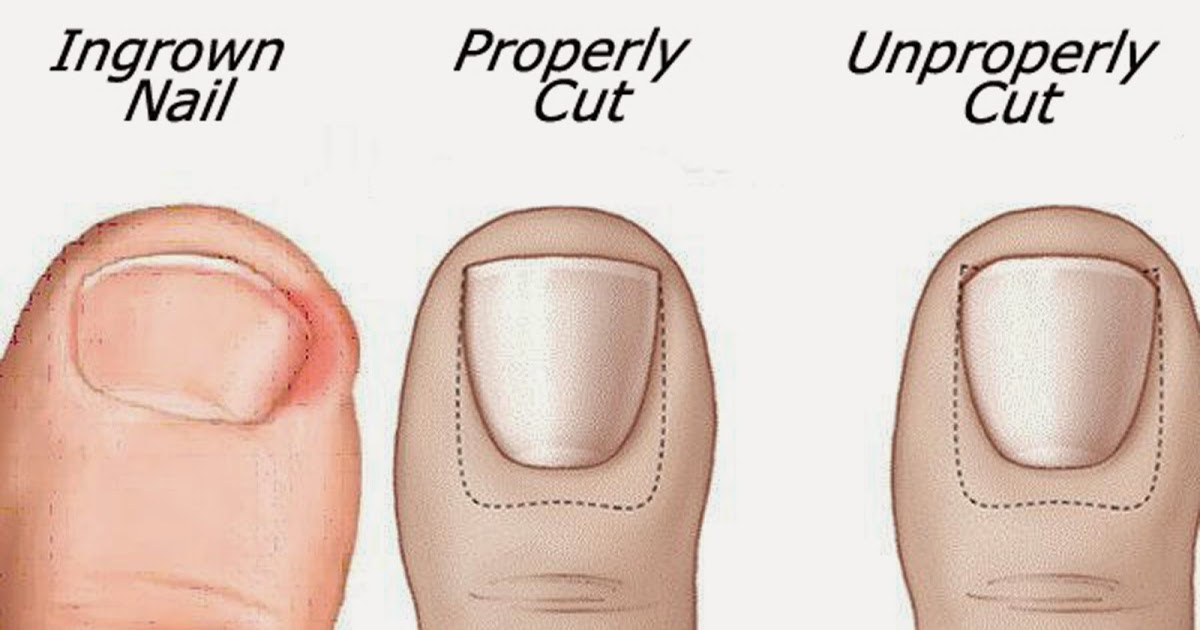 Natural Ways To Get Rid Of An Ingrown Toenail Without Surgery Small Joys