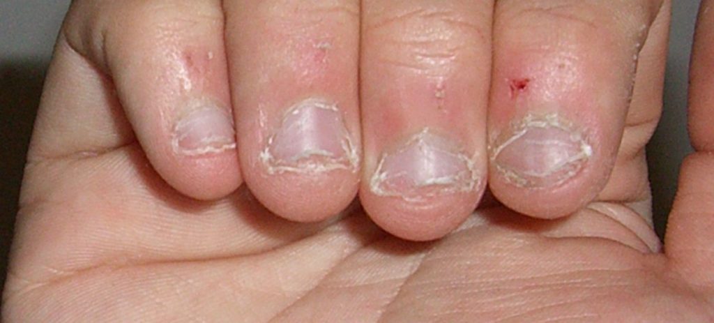 Un hombre de 28 años, a punto de morir por morderse las uñas