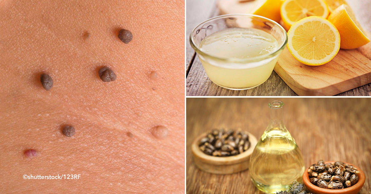 Porque salen bolitas en las axilas_3