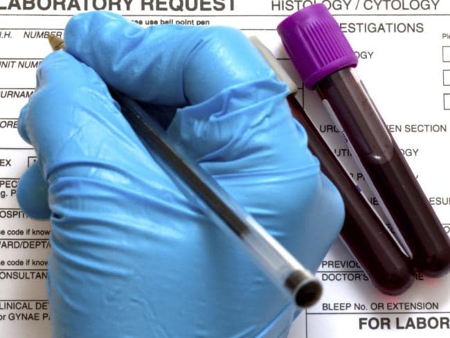 Résultat de l'image pour Un nouveau test sanguin peut détecter dix cancers différents ANS avant que quelqu'un ne tombe malade