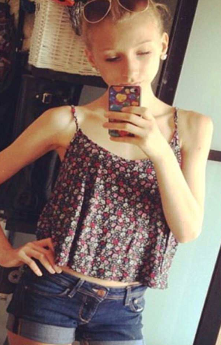 Anorexic Teen Who Lived On Nothing But Chewing Gum