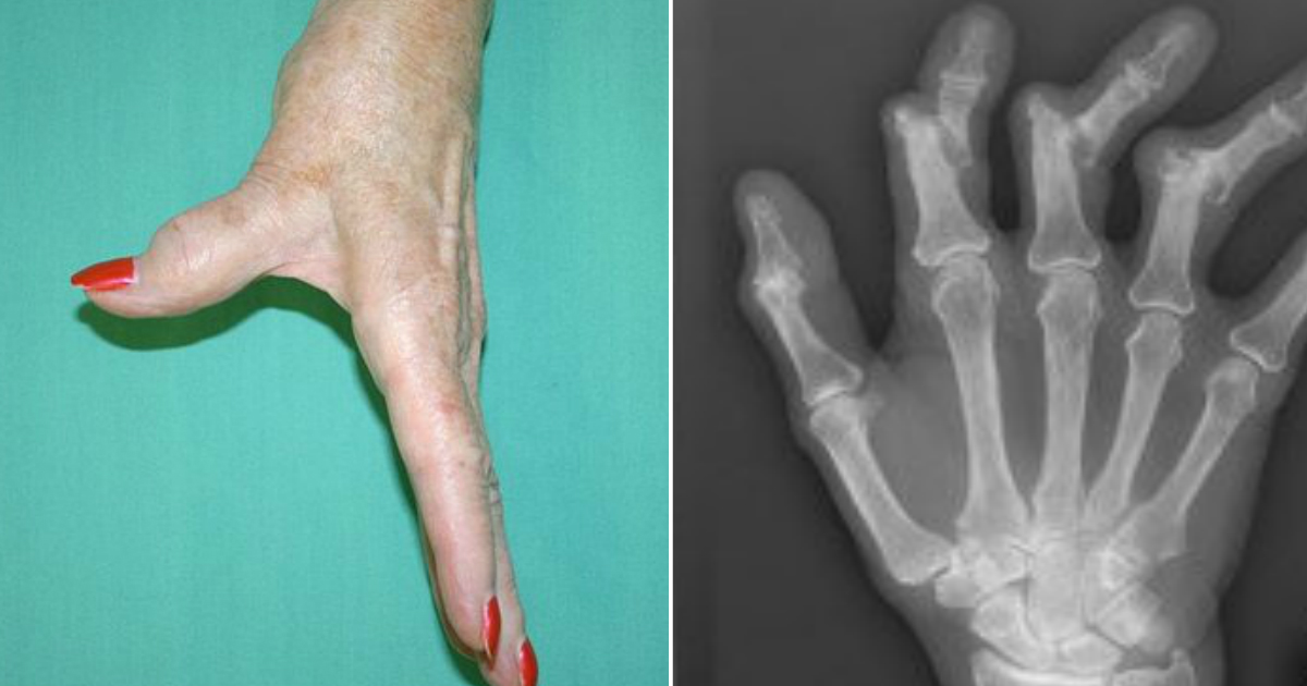 5 Early Signs Of Arthritis People Should Be Aware Of