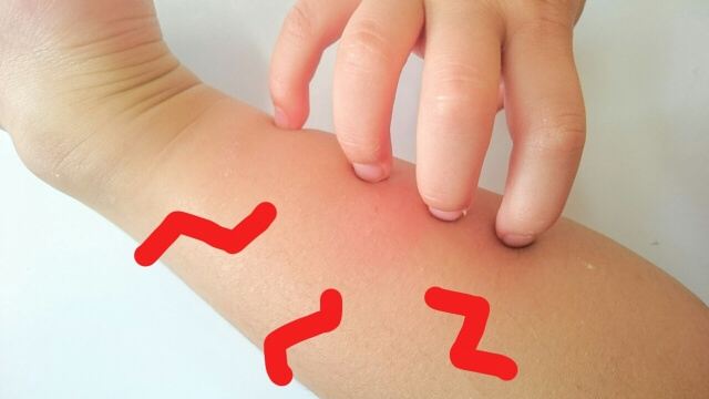 Image result for 蚊に刺される