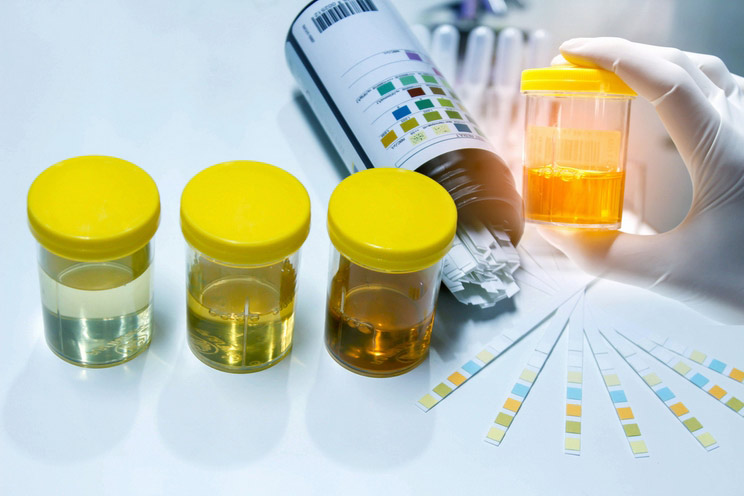 Urine-sample-with-reagent-strip-for-urinalysis-in-laboratory.jpg