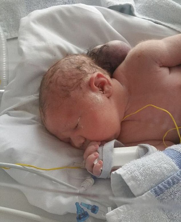 Miracle Baby Born With Brain Outside Her Head Now She Has Defied Odds To Survive Small Joys