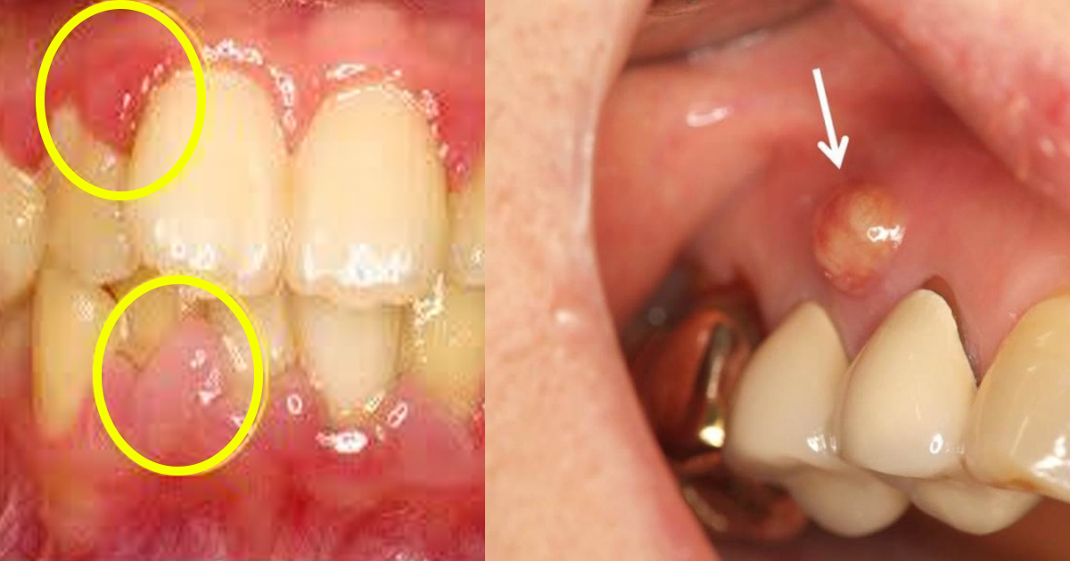 歯茎 の 腫れ 対処 法