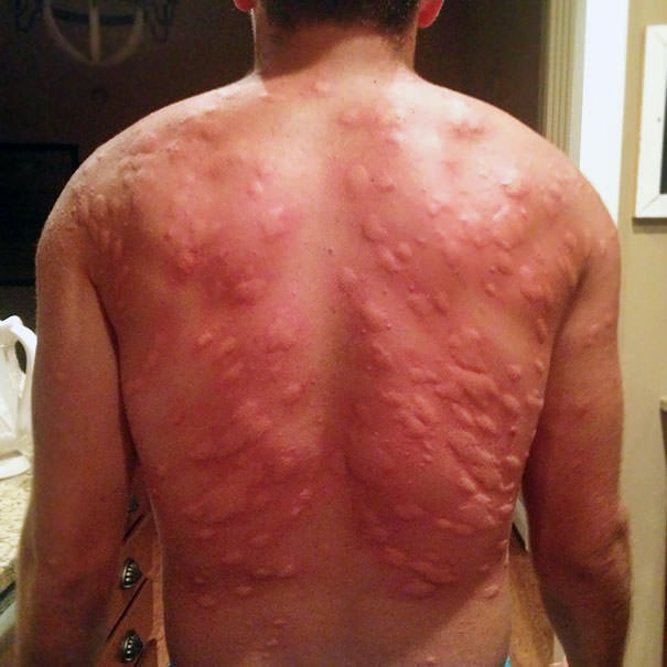 My Buddy Forgot Bug Spray Last Night