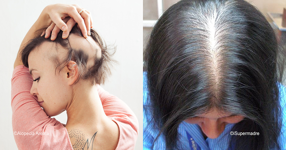 Todo Sobre La Alopecia Femenina Y Sus Tratamientos Va A Gustarme 5536