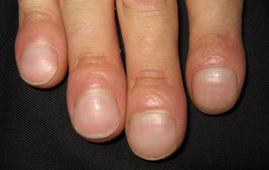 hand-health-signs-you-can-know_clubbed-nails.jpg