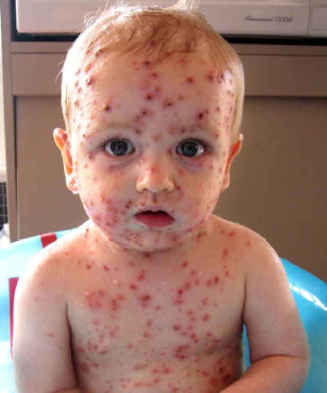 Chickenpox4 