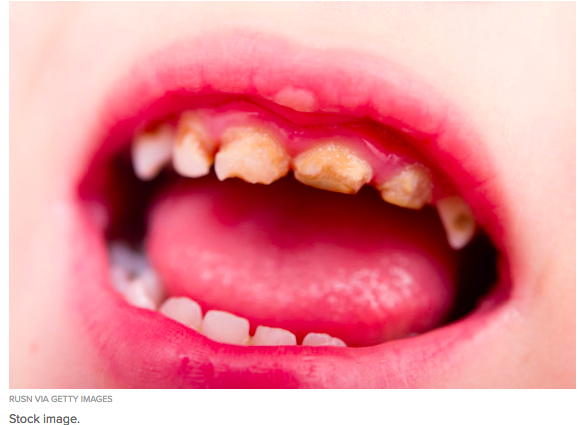 Abandonneriez Vous Votre Cannette De Coca Cola S Il Y Avait Une Photo De Dents Pourries Dessus Vonjour