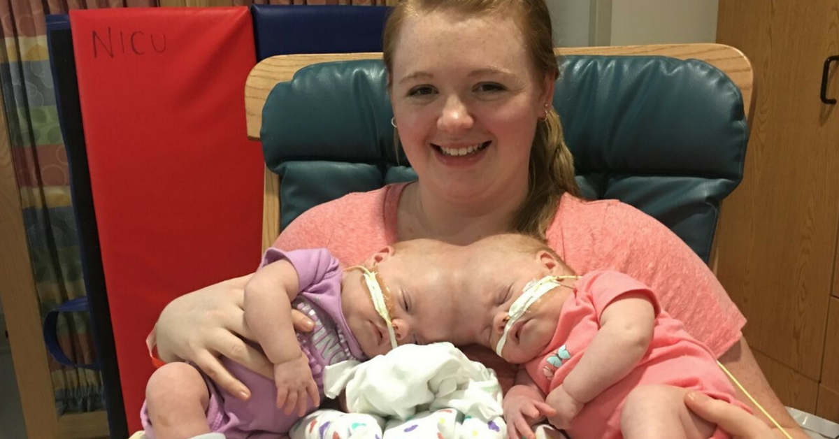 Image result for Conjoined twins can finally go home to sleep in own beds after risky surgery