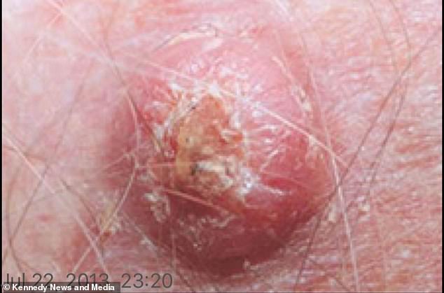 The wart, pictured, concerned Mrs Smith and her hairdresser, but she was told not to worry