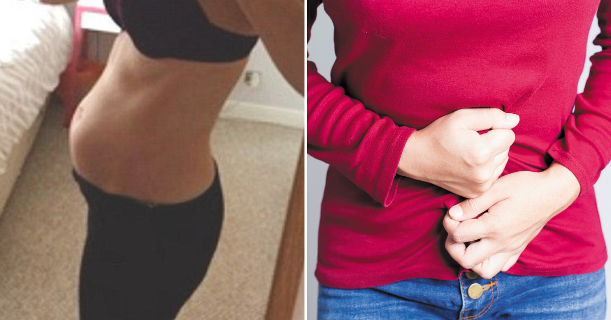 21-year-old-woman-whose-stomach-was-bloated-for-months-discovered-what