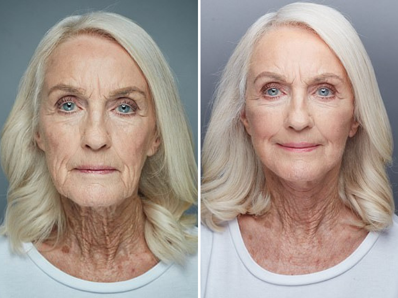 Great Grandmother Spent Years Saving Her Pension For $13K Face Lift ...