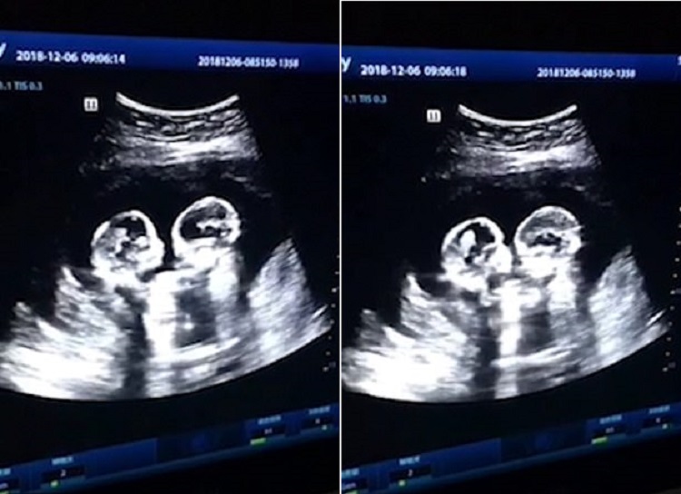 Routine Ultrasound Scan Revealed Identical Twin Sisters "Fighting"...