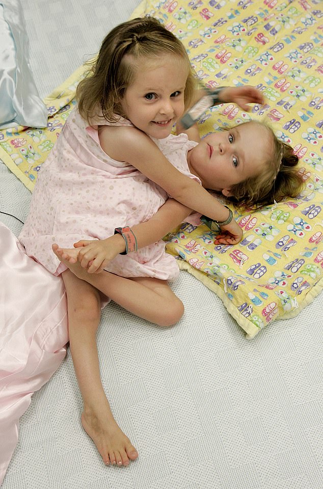 Conjoined Twins Who Have One Leg EACH After Separation Surgery Now.