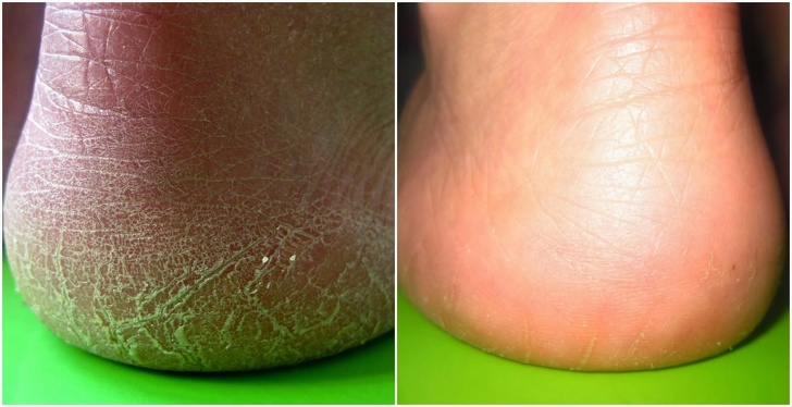 10 Maneras rápidas para deshacerte de los callos y hacer que tus pies sean suaves como los de un bebé