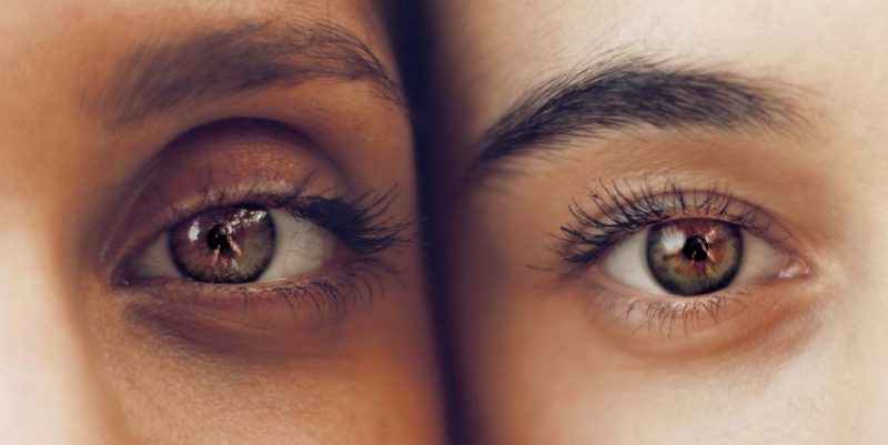 Resultado de imagen de ojeras