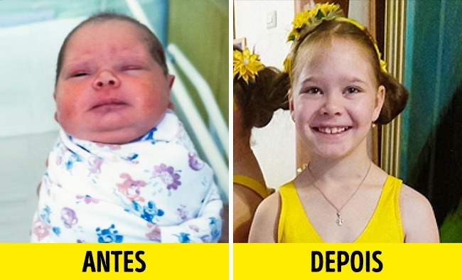 12 Fotos de crianças antes e depois de serem adotadas