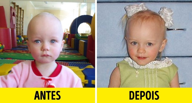 12 Fotos de crianças antes e depois de serem adotadas