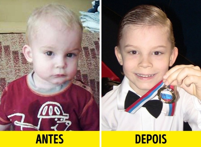 12 Fotos de crianças antes e depois de serem adotadas