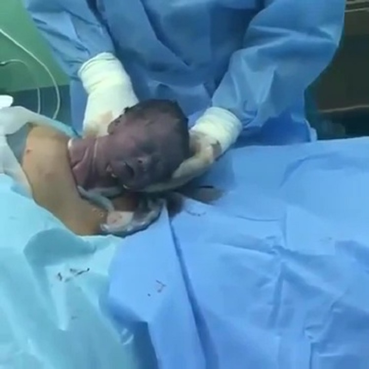 Newborn Crawled Out Of The Womb  During A Gentle C Section 