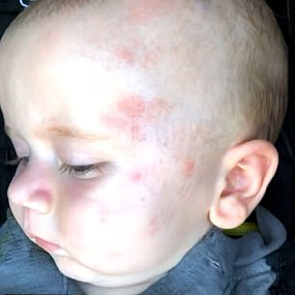 6MonthOld Baby Had Internal Bleeding And Was Left With HandShaped