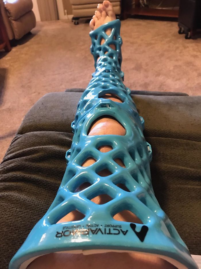 My Moms 3D Printed Cast. She Can Take A Shower With It! My Moms 3D Printed Cast. She Can Take A Shower With It!